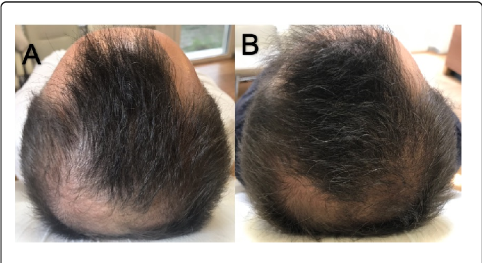 Minoxidil results at baseline and after 24 weeks