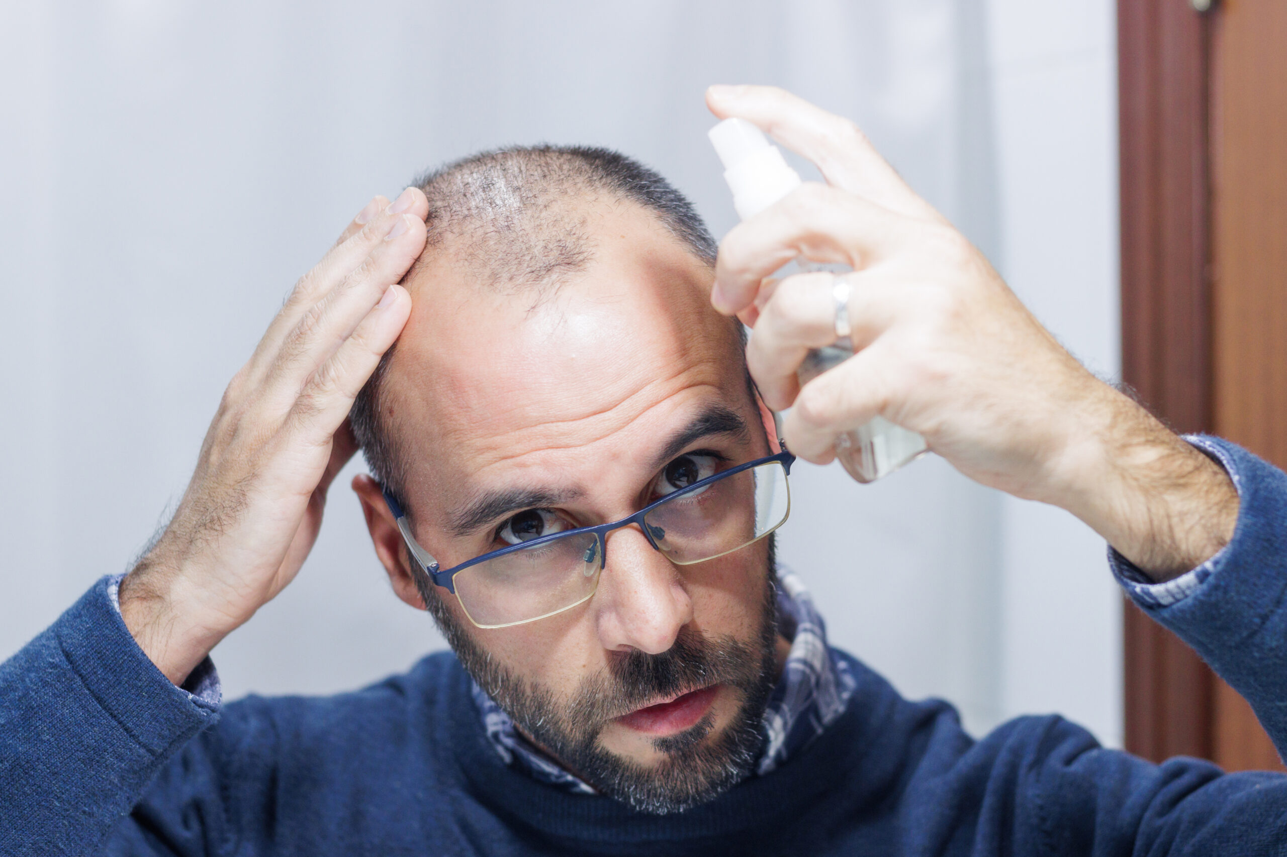 Man applying topical finasteride