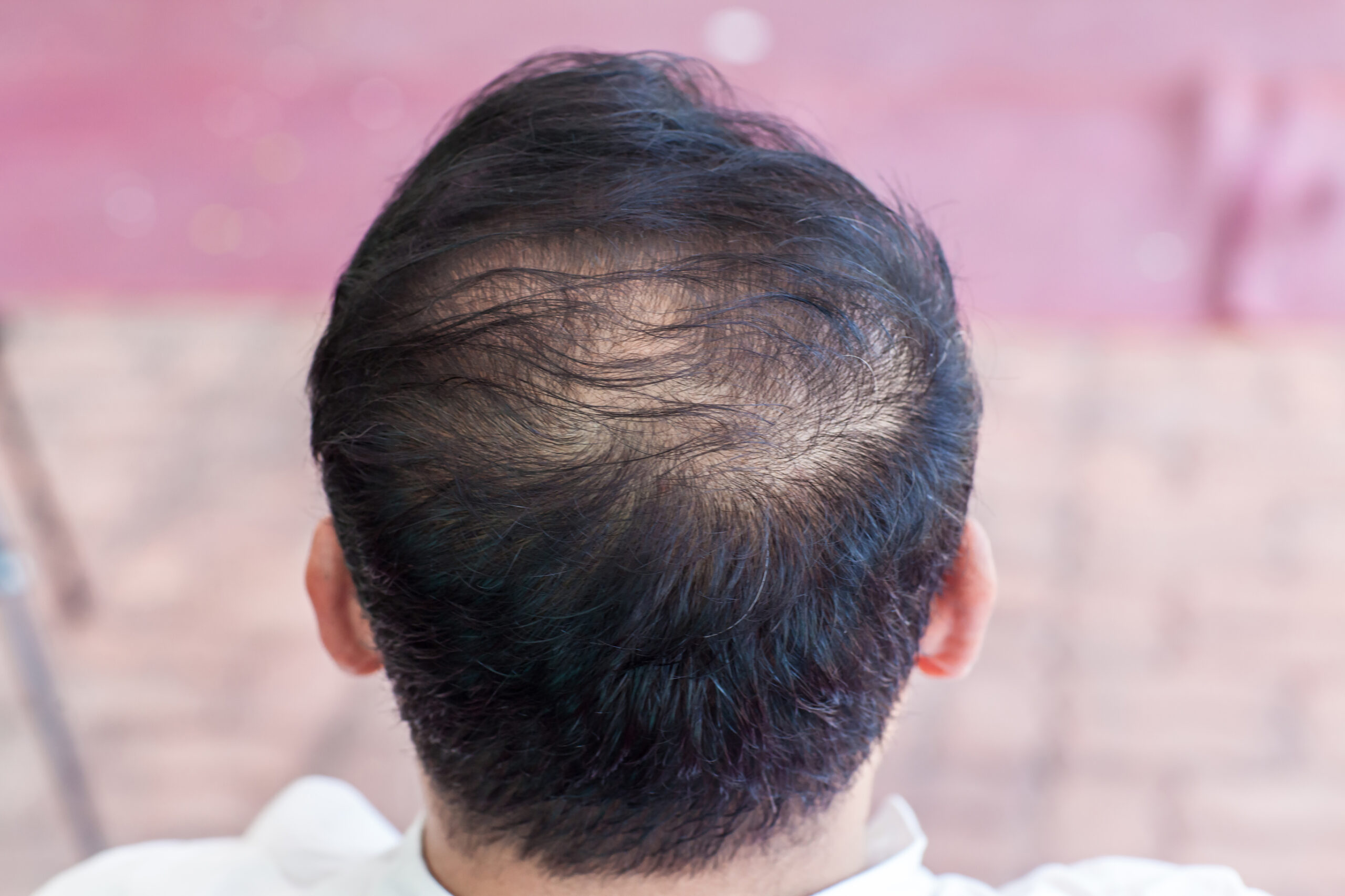 Man with crown hair loss