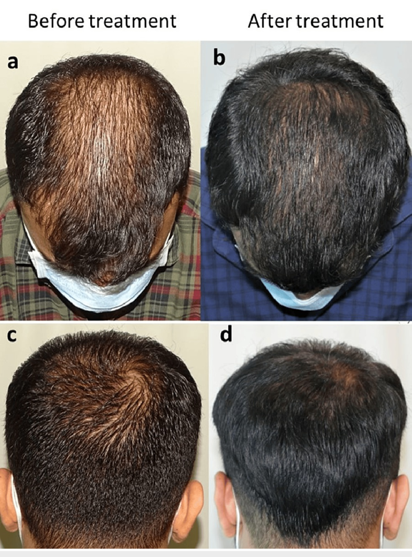 Results from cetosomal minoxidil after 16 weeks