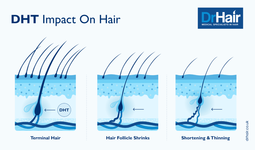 DHT impact on hair