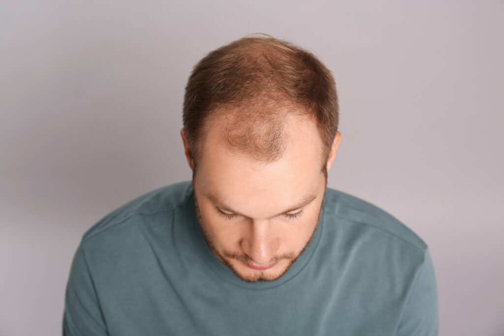 Early mid-scalp thinning
