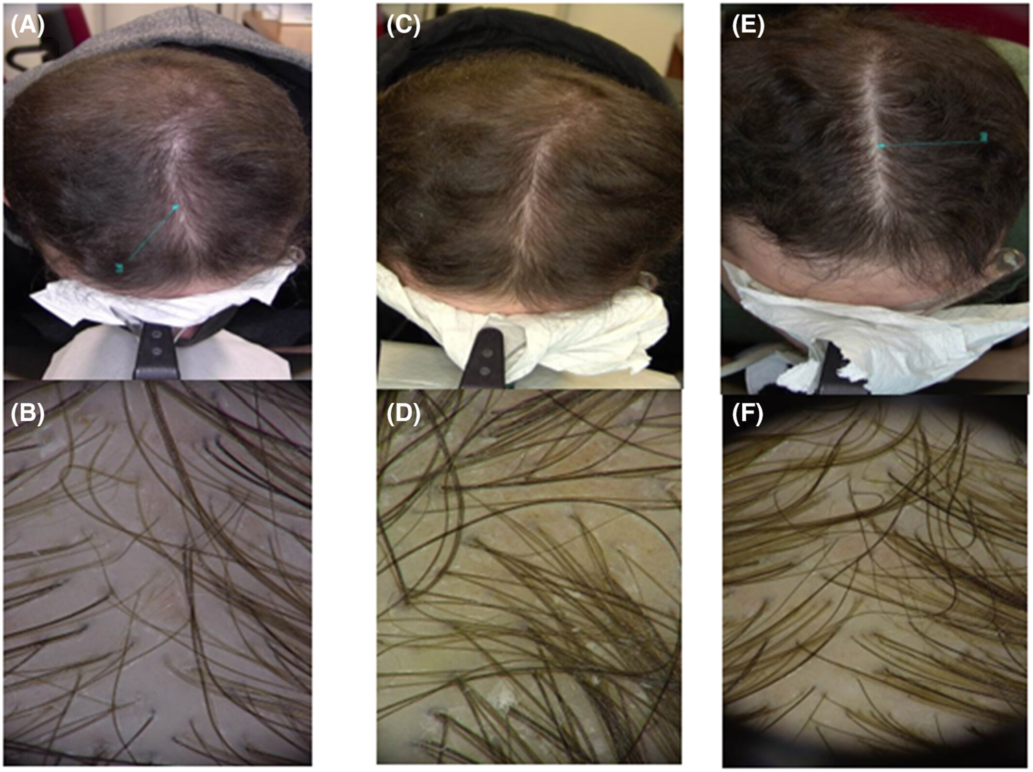 Hair growth following topical finasteride + minoxidil