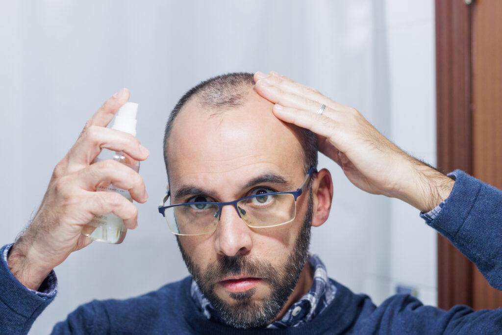 Man spraying hair loss product on scalp
