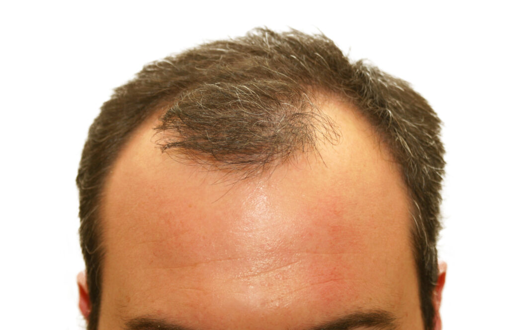 Receding hairline
