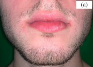 A set of twins, one of which used Minoxidil for 16 weeks