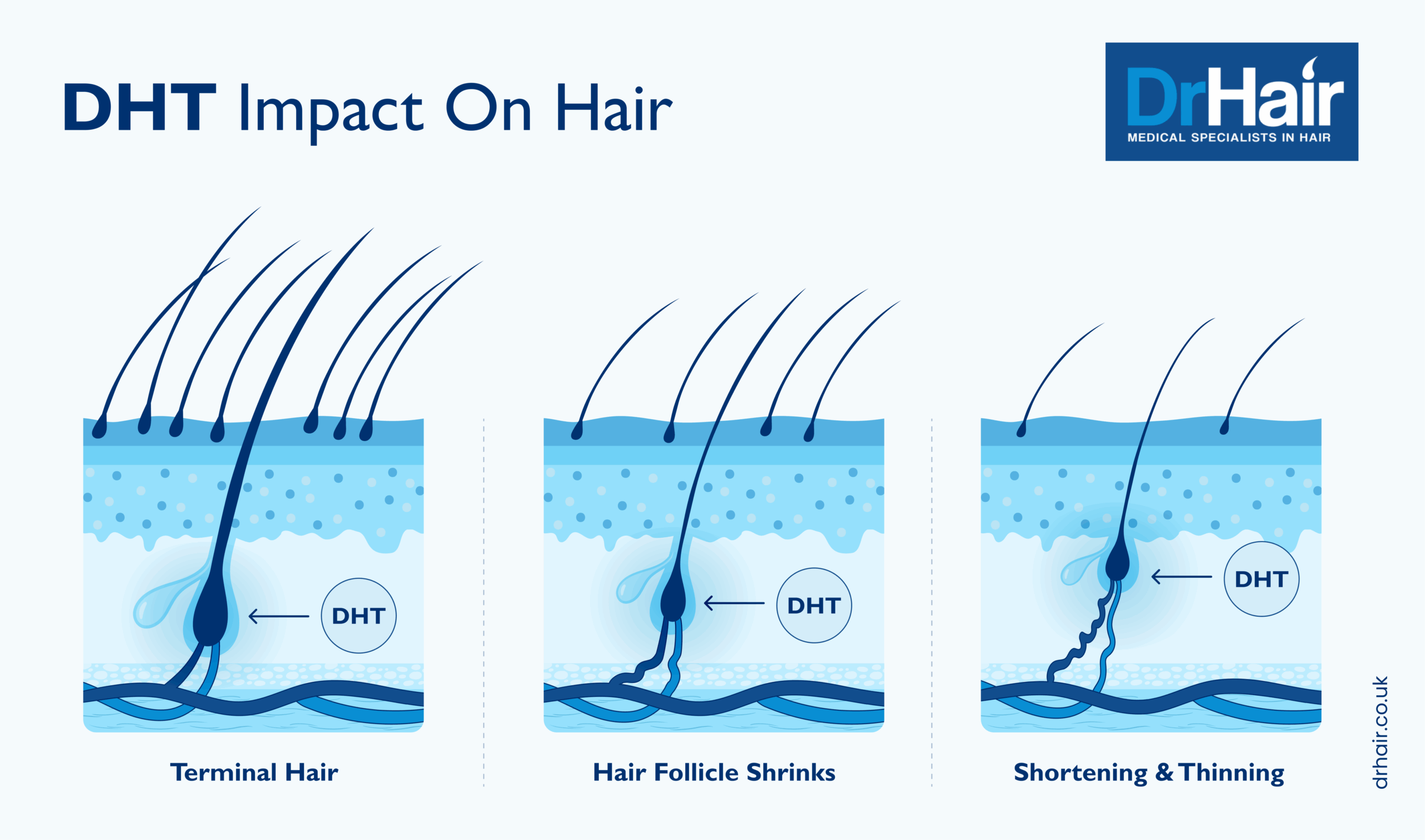 DrHair diagram showing DHT impact on hair at the hair follicle level.