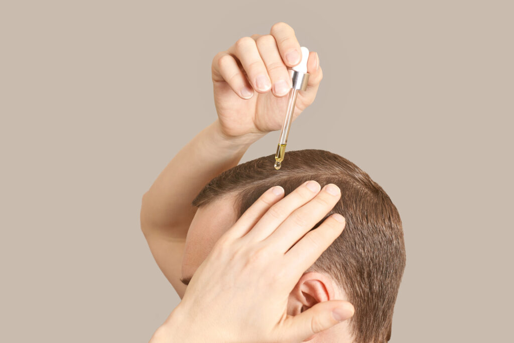 Man applying topical finasteride
