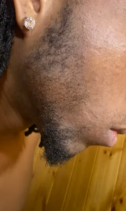 Man before, 3 and 4 months into minoxidil beard treatment