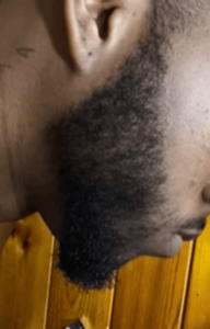 Man before, 3 and 4 months into minoxidil beard treatment