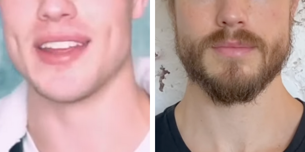 Man before and 1 year after minoxidil beard treatment