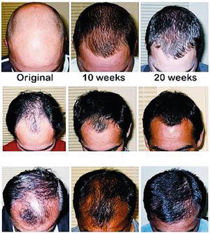 Finasteride results in 3 patients at baseline, 10 weeks, and 20 weeks. Source: [12].