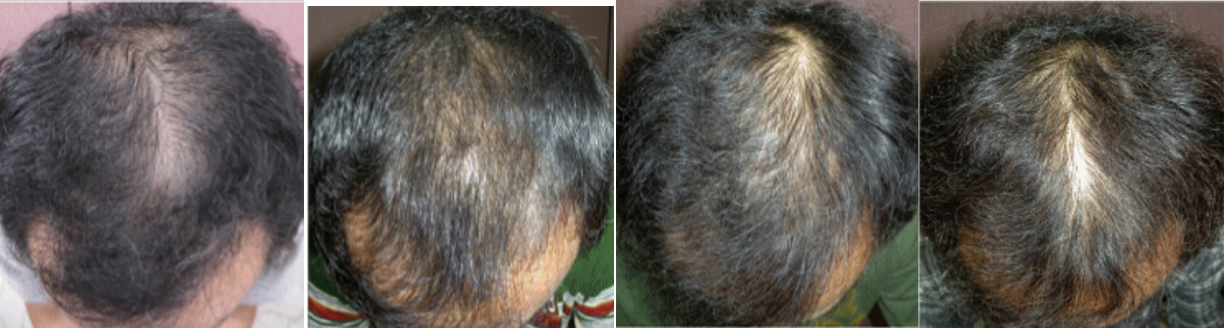The photo series below shows one patient after two to nine years of continuous Finasteride use [1]: