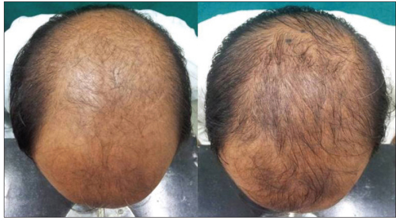 Patient before Finasteride treatment and after 6 months of taking 1 mg per day. Image source: [2]